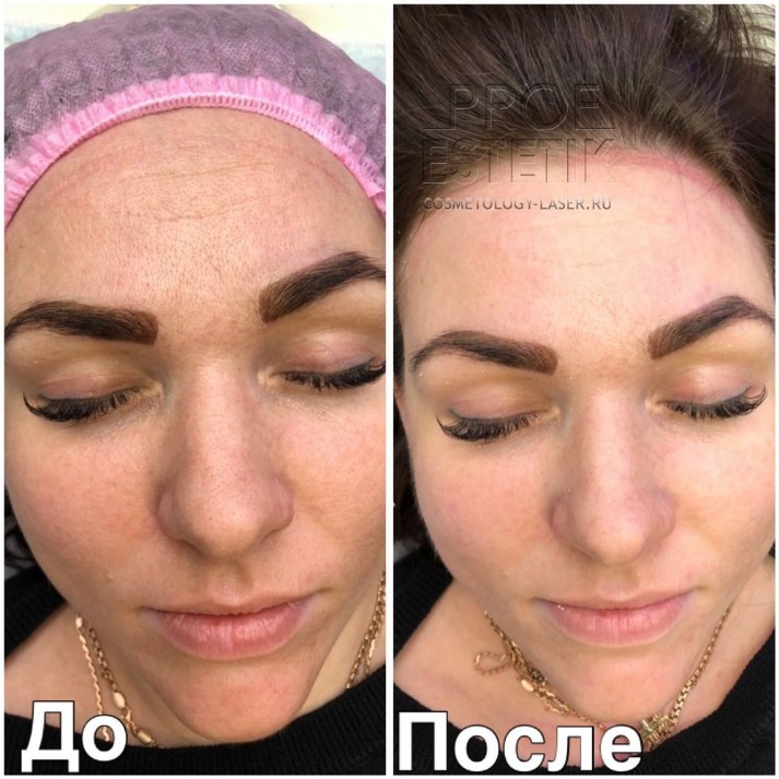 HydraFacial Алмазный пилинг