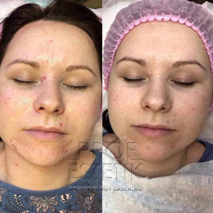 HydraFacial борьба с акне фото до и после