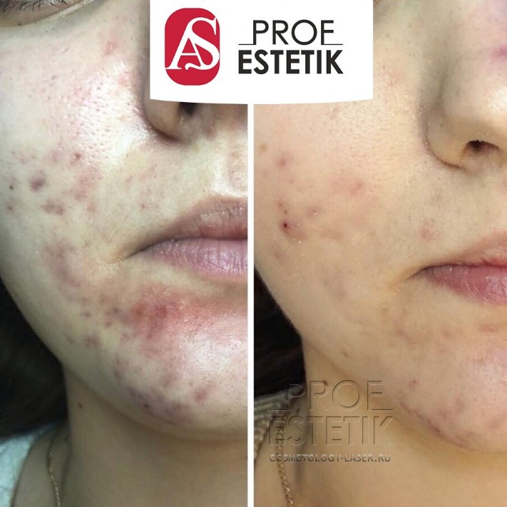 HydraFacial акне акнэ угри прыщи