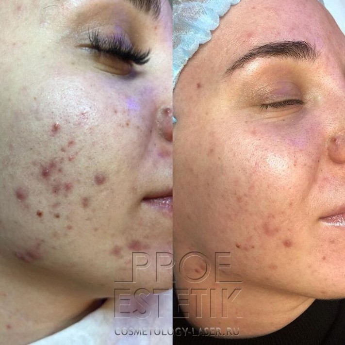 HydraFacial акне акнэ угри прыщи